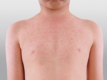 GOS Measles